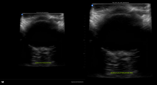 Utilizing Convolutional Neural Networks for Human Eye Ultrasonography Analysis